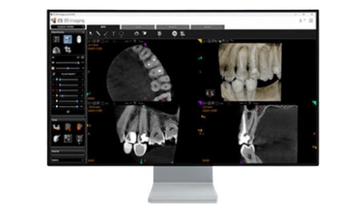 Resolución CBCT de 75 micras para detalle clínico endodóntico