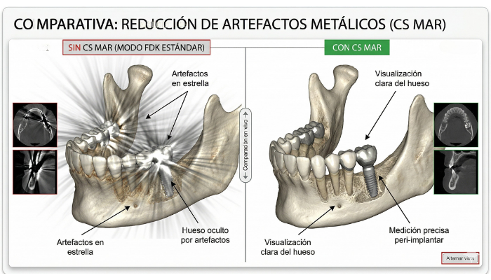 Comparativa de mandíbula con y sin CS MAR